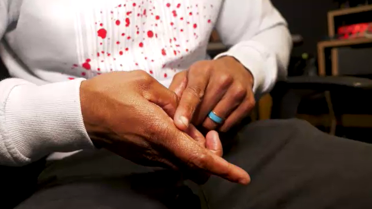 Daniel has a scar on his hand 